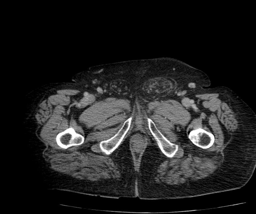 Nephroptosis with inguinal hernia containing perirenal fat (Radiopaedia 56632-63391 C 350).jpg