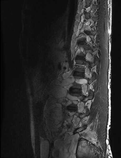 File:Neurofibromatosis type 1 (Radiopaedia 11671-12034 Sagittal T1 1).jpg