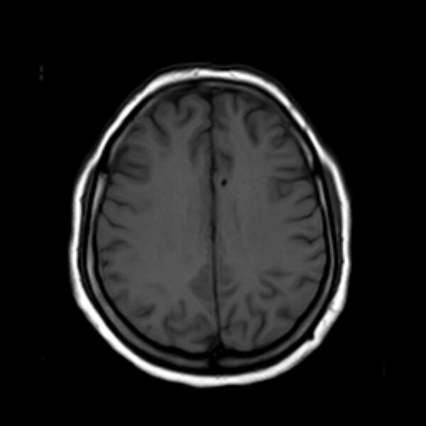 File:Neurofibromatosis type 2 (Radiopaedia 67470-76871 Axial T1 16).jpg