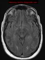 Neuroglial cyst (Radiopaedia 10713-11184 Axial FLAIR 13).jpg