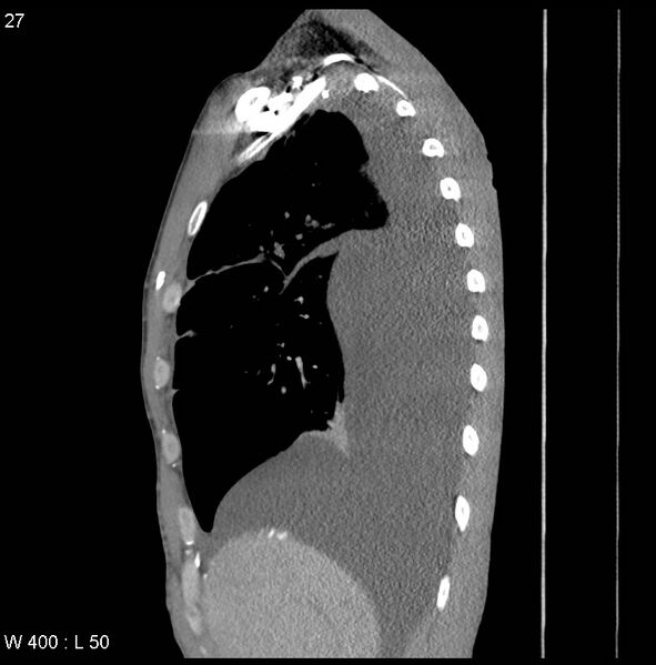 File:Non-Hodgkin lymphoma involving lung (Radiopaedia 29094-29470 D 18).jpg