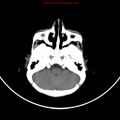 Non-accidental injury - bilateral subdural with acute blood (Radiopaedia 10236-10765 Axial non-contrast 4).jpg