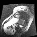 Non-compaction of the left ventricle (Radiopaedia 38868-41062 E 3).jpg