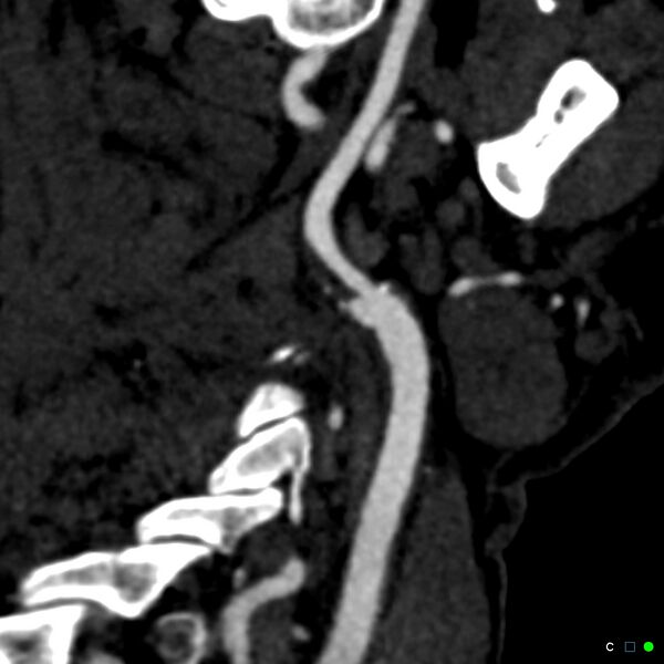 File:Non-occlusive intraluminal internal carotid artery thrombus (Radiopaedia 37751-39658 C 16).jpg