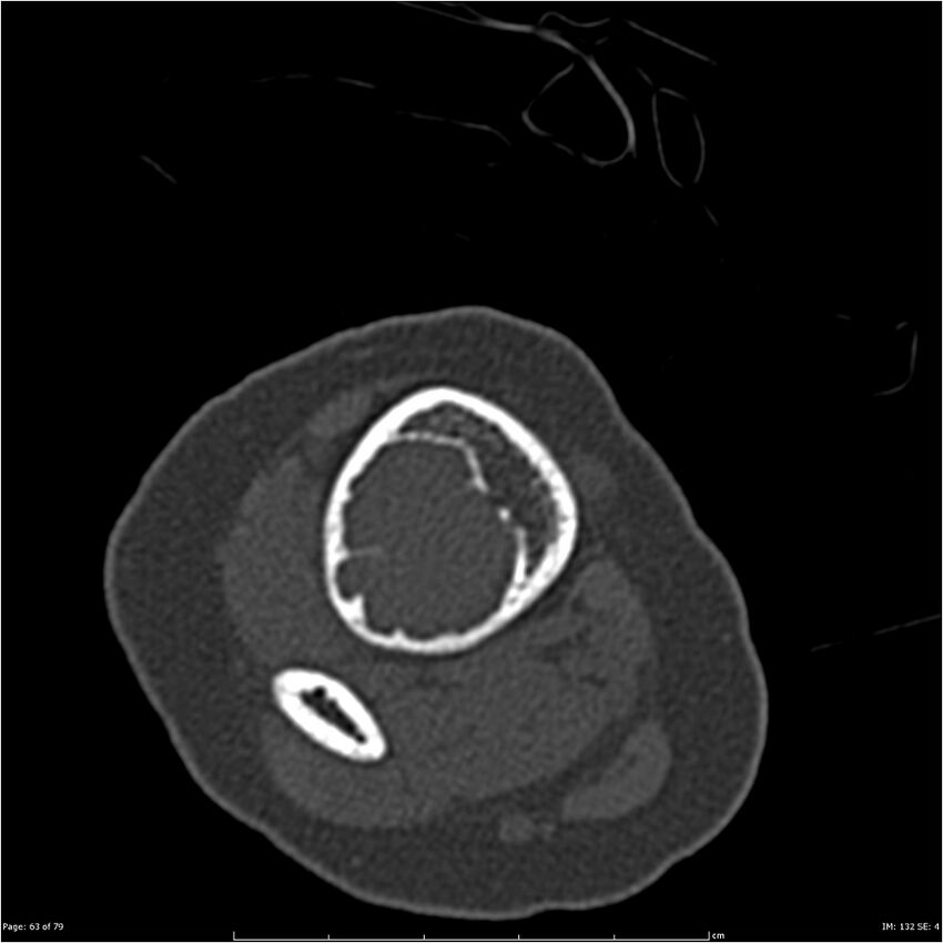 Non-ossifying fibroma (Radiopaedia 23651-23780 bone window 63).jpg