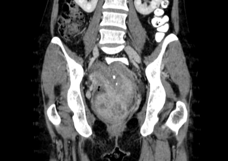 File:Non-puerperal uterine inversion (Radiopaedia 78343-91094 B 22).jpg