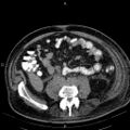 Non Hodgkin lymphoma in a patient with ankylosing spondylitis (Radiopaedia 84323-99621 Axial non-contrast 44).jpg