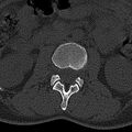 Normal CT lumbar spine (Radiopaedia 53981-60118 Axial bone window 30).jpg