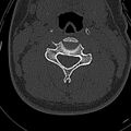 Normal CT of the cervical spine (Radiopaedia 53322-59305 Axial bone window 128).jpg