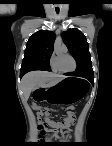 File:Normal CT virtual gastroscopy (Radiopaedia 29960-30501 E 15).jpg