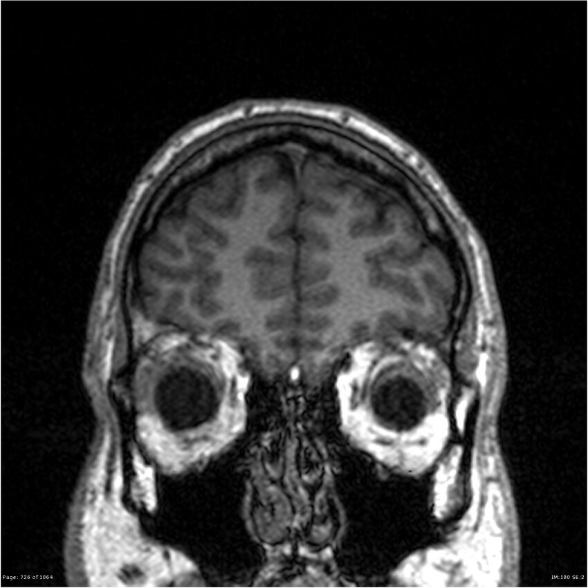 Normal brain MRI (non-focal epilepsy protocol) (Radiopaedia 38571-40700 Coronal T1 89).jpg