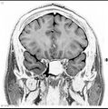 Normal coronal brain (Radiopaedia 6676-7910 B 12).jpg