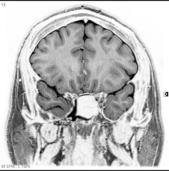 File:Normal coronal brain (Radiopaedia 6676-7910 B 12).jpg
