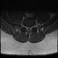 Normal lumbar spine MRI (Radiopaedia 47857-52609 Axial T1 27).jpg