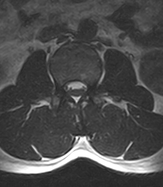 File:Normal lumbar spine MRI - low-field MRI scanner (Radiopaedia 40976-43699 Axial T2 37).jpg