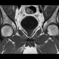 Normal prostate (MRI) (Radiopaedia 29986-30535 Coronal T1 7).jpg