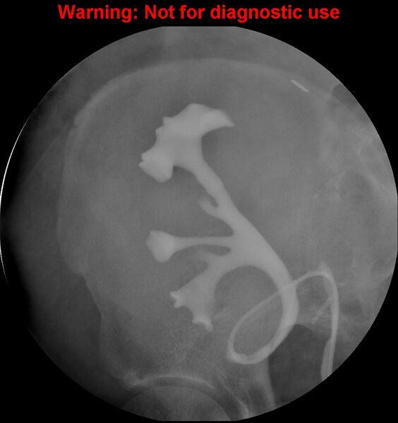 File:Normal retrograde pyelography of a native and transplant kidney (Radiopaedia 40480-43054 Transplant kidney 21).jpg