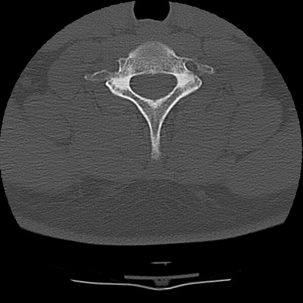 File:Normal trauma spine imaging (Radiopaedia 31753-32686 Axial bone window 65).jpg