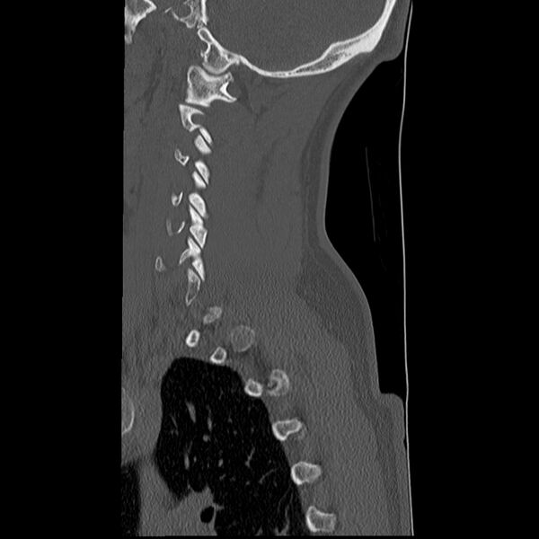 File:Normal trauma spine imaging (Radiopaedia 31753-32686 Sagittal bone window 7).jpg