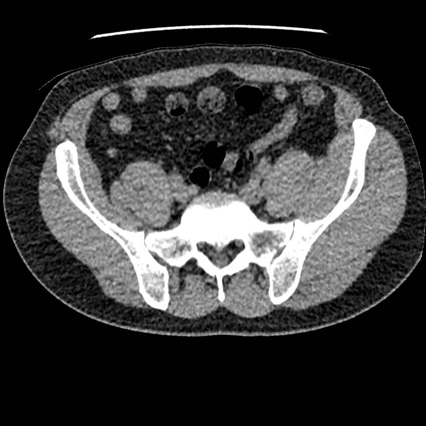 Obstructing ureteric calculus and ureteric anatomy (Radiopaedia 62730-71042 Axial non-contrast 115).jpg