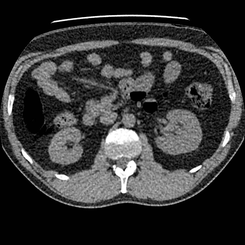 Obstructing ureteric calculus and ureteric anatomy (Radiopaedia 62730-71042 Axial non-contrast 39).jpg