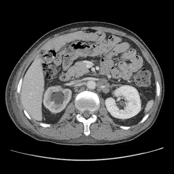 File:Obstructive bladder transitional cell carcinoma (Radiopaedia 9825-10410 A 8).jpg