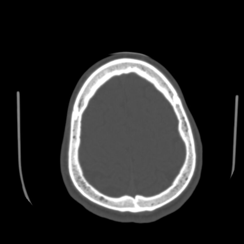 Occipital spur - asymptomatic (Radiopaedia 87753-104201 Axial bone window 177).jpg