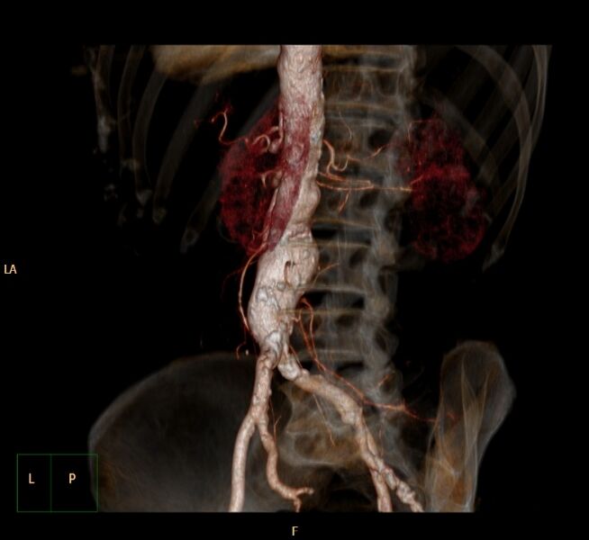 File:Abdominal aortic aneurysm (Radiopaedia 23703-23856 3D 16).jpg