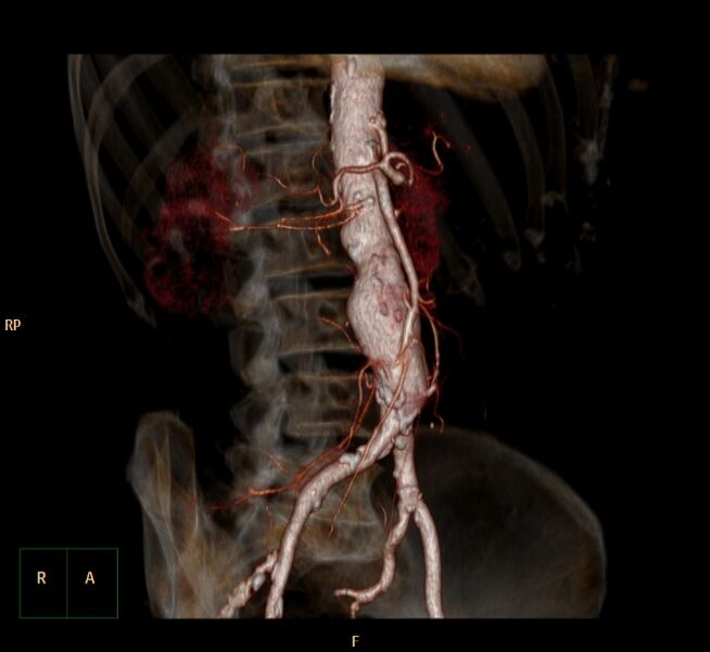 File:Abdominal aortic aneurysm (Radiopaedia 23703-23856 3D 4).jpg