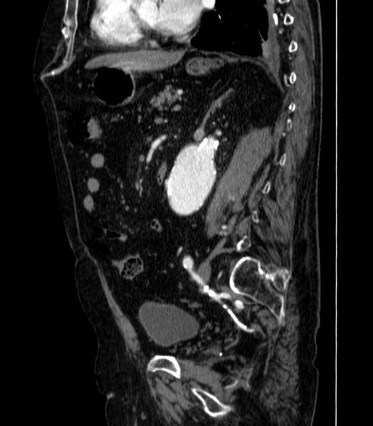 File:Abdominal aortic aneurysm (Radiopaedia 25855-26001 Sagittal C+ arterial phase 39).jpg