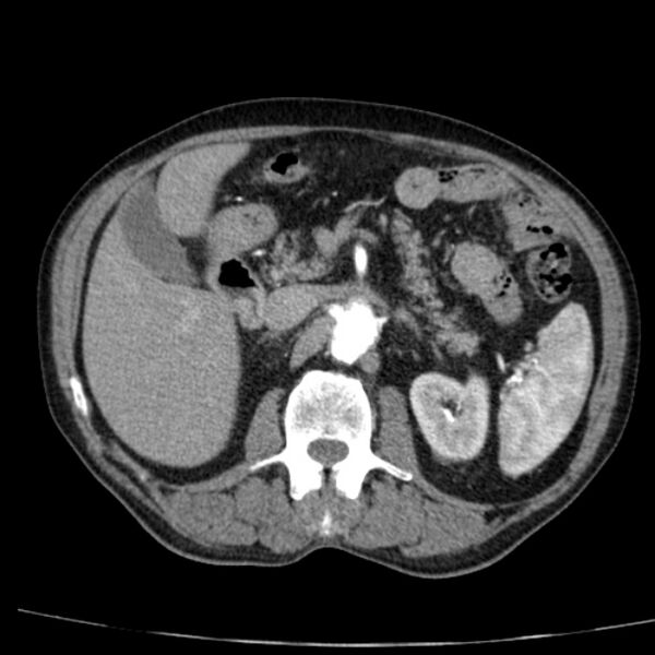 File:Abdominal aortic aneurysm (Radiopaedia 29248-29660 Axial C+ arterial phase 30).jpg