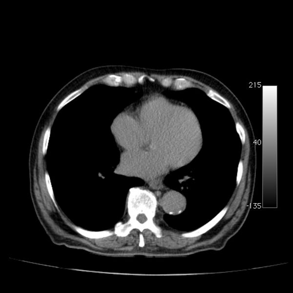 File:Abdominal aortic aneurysm (Radiopaedia 29248-29660 Axial non-contrast 1).jpg