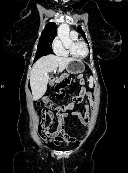 File:Abdominal aortic aneurysm (Radiopaedia 85063-100606 Coronal C+ arterial phase 13).jpg