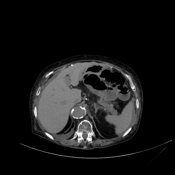 File:Abdominal aortic aneurysm - impending rupture (Radiopaedia 19233-19246 Axial non-contrast 33).jpg