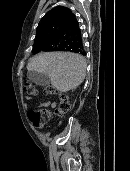File:Abdominal aortic aneurysm rupture (Radiopaedia 54179-60362 Sagittal C+ arterial phase 6).jpg