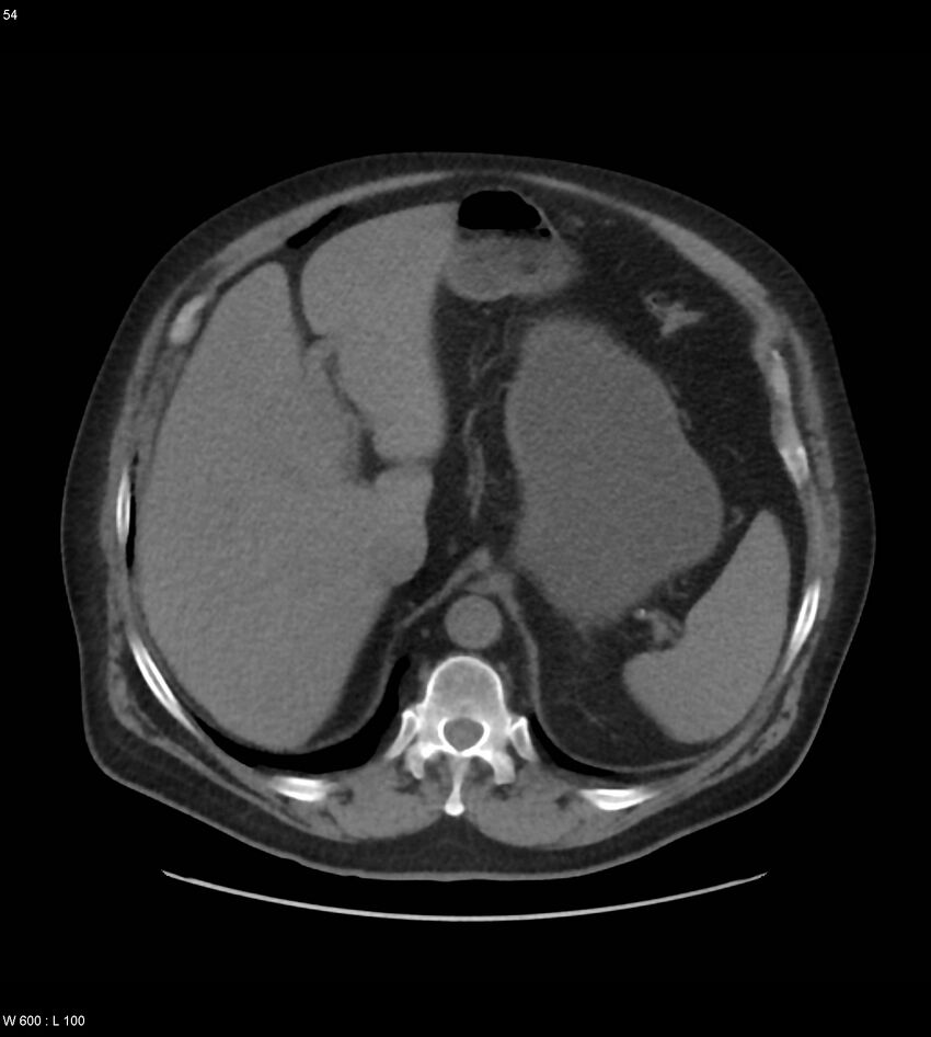 Abdominal aortic aneurysm with intramural hematoma then rupture (Radiopaedia 50278-55631 Axial non-contrast 50).jpg