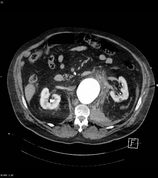 File:Abdominal aortic aneurysm with intramural hematoma then rupture (Radiopaedia 50278-55632 Axial C+ arterial phase 69).jpg