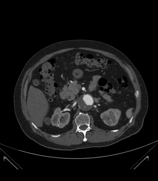 File:Abdominal aortic aneurysm with thrombus fissuration (Radiopaedia 46218-50618 Axial C+ arterial phase 13).jpg