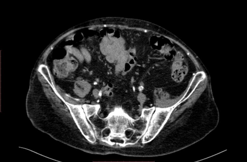 Abdominal aortic interposition tube graft and aneurysm thrombosis (Radiopaedia 71438-81857 Axial C+ arterial phase 163).jpg