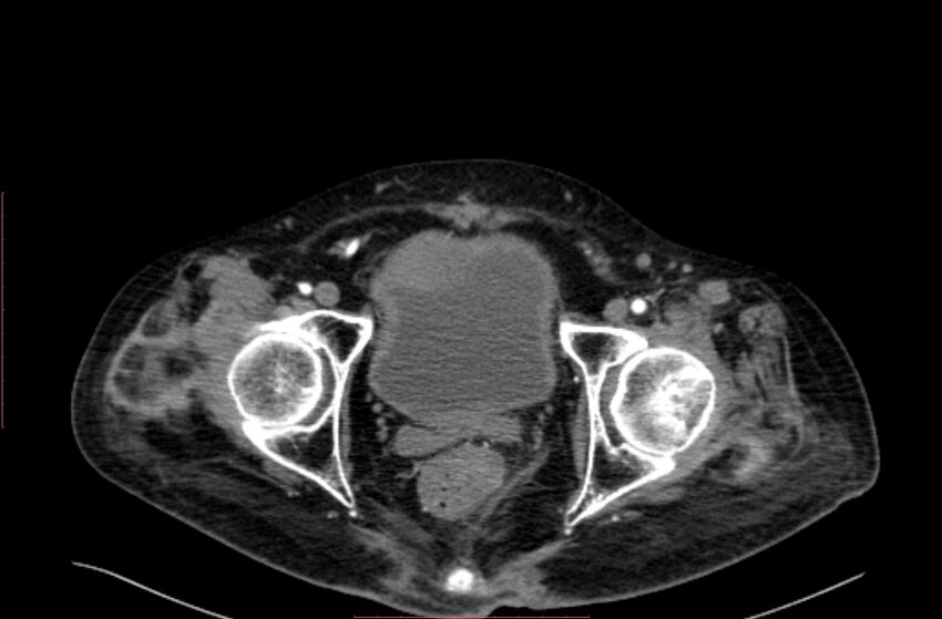 Abdominal aortic interposition tube graft and aneurysm thrombosis (Radiopaedia 71438-81857 Axial C+ arterial phase 227).jpg