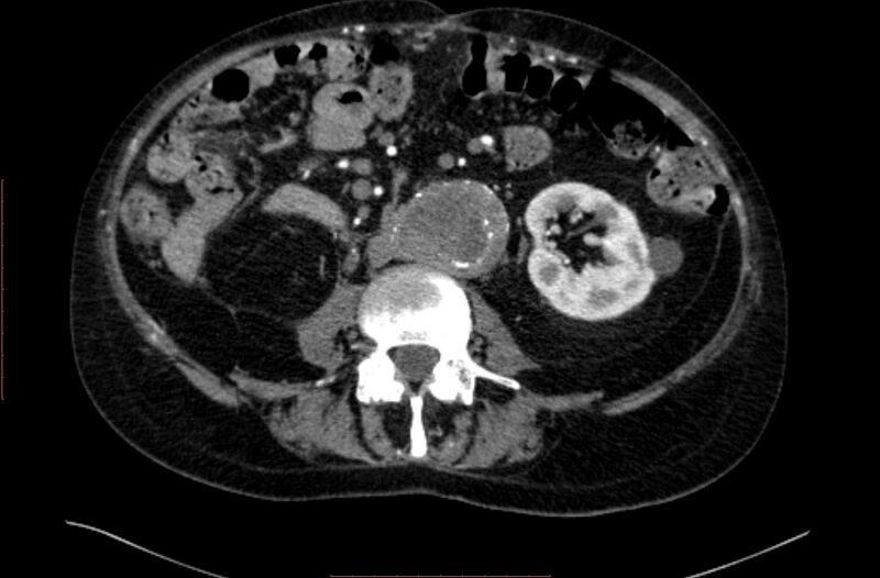 File:Abdominal aortic interposition tube graft and aneurysm thrombosis (Radiopaedia 71438-81857 Axial C+ arterial phase 88).jpg