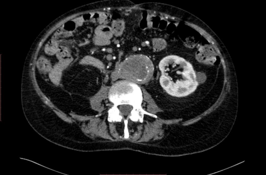 Abdominal aortic interposition tube graft and aneurysm thrombosis (Radiopaedia 71438-81857 Axial C+ arterial phase 88).jpg
