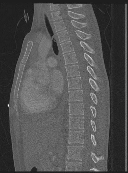 File:Abdominal multi-trauma - devascularised kidney and liver, spleen and pancreatic lacerations (Radiopaedia 34984-36486 Sagittal bone window 33).png