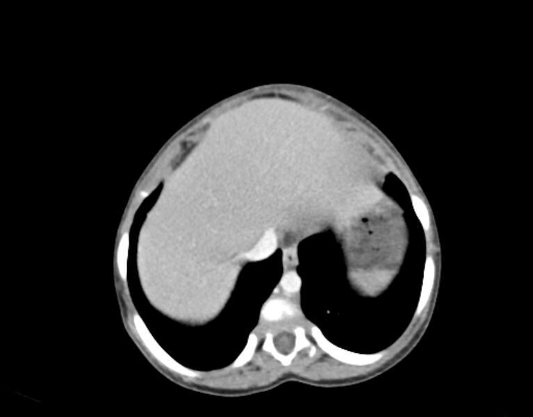 File:Abdominal premesenteric cystic lymphangioma (Radiopaedia 82995-97350 Axial C+ portal venous phase 2).jpg