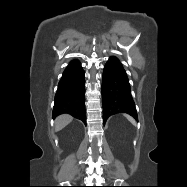 File:Aberrant right subclavian and left vertebral arteries (Radiopaedia 43467-46847 Coronal C+ portal venous phase 72).jpg