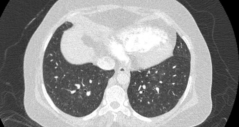 File:Accessory right inferior hepatic vein (Radiopaedia 65245-74259 Axial lung window 57).jpg