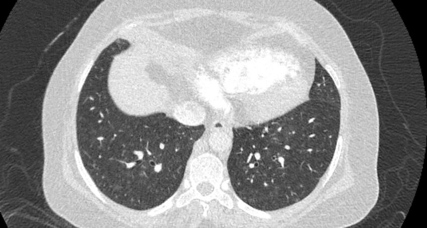 Accessory right inferior hepatic vein (Radiopaedia 65245-74259 Axial lung window 57).jpg