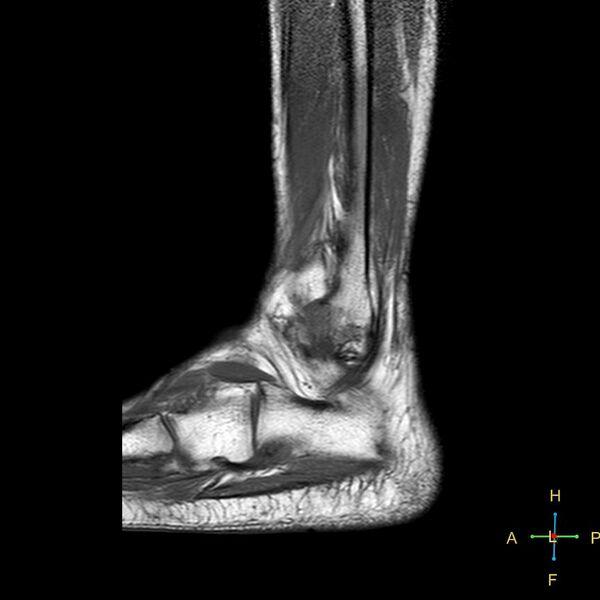 File:Achilles tendon complete tear (Radiopaedia 22834-22854 Sagittal T1 3).jpg