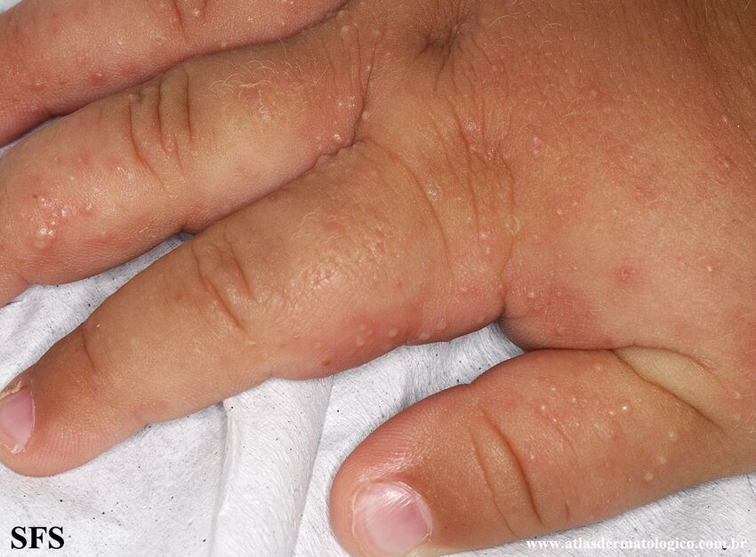 Acropustulosis Infantile (Dermatology Atlas 11).jpg