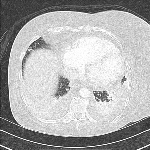 File:Acute-on-chronic pulmonary emboli (Radiopaedia 27925-28169 lung window 36).jpg